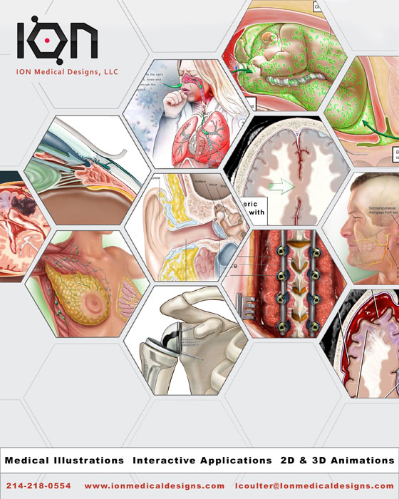 ION Medical Designs, LLC, Medical Illustrations, Interactive Applications, 2D & 3D Animations